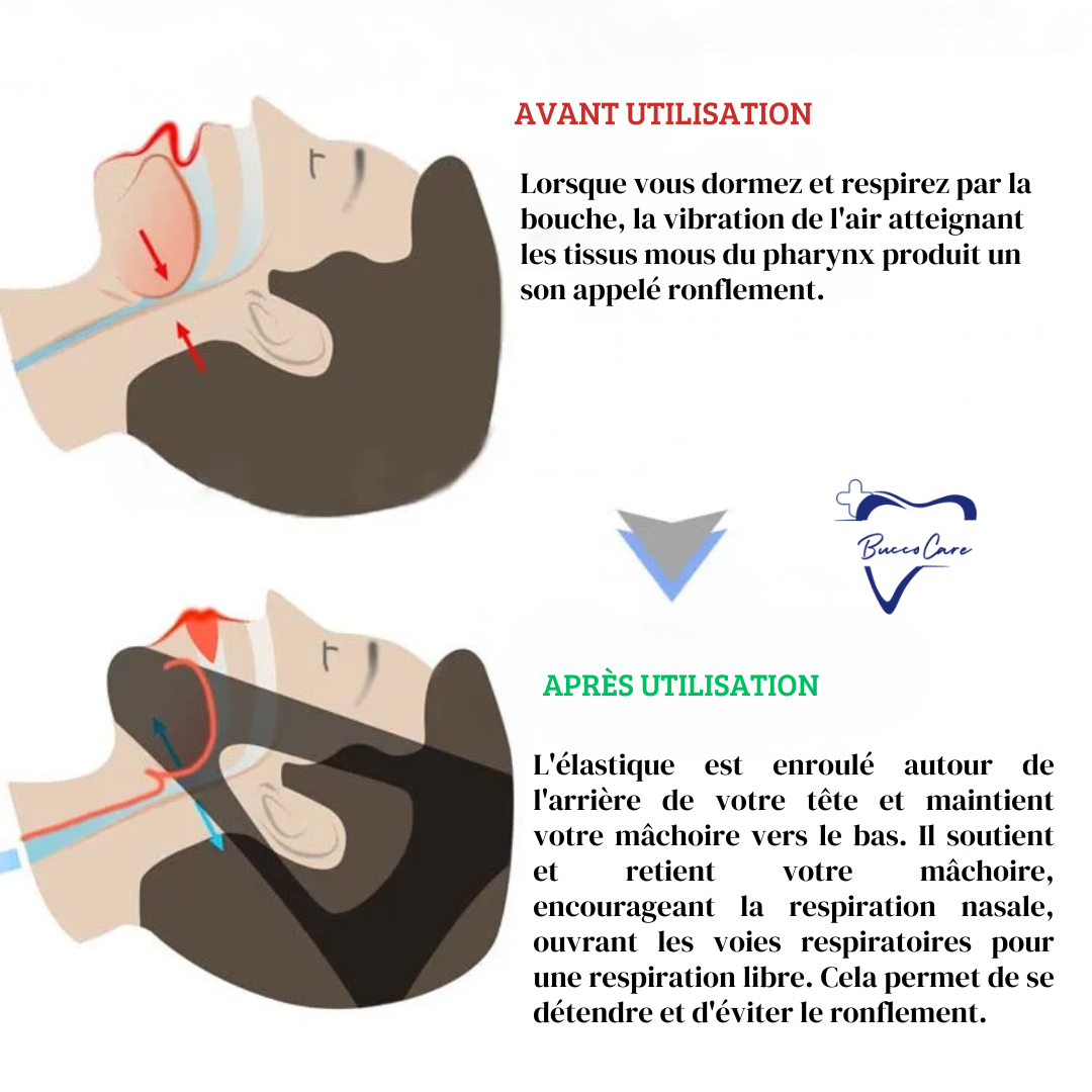 Orthèse anti-ronflement ergonomique bleue, conçue pour le confort et la réduction du bruit nocturne. Solution apnée du sommei