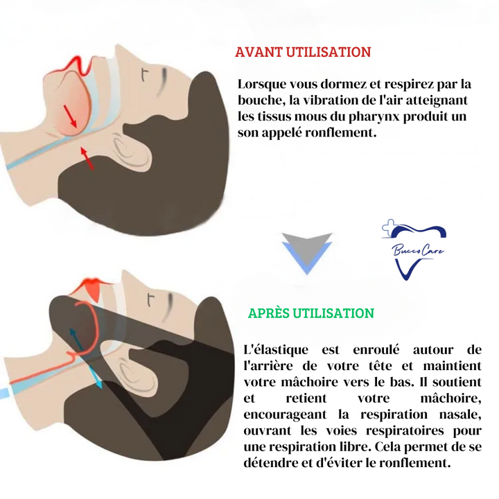 Orthèse anti-ronflement ergonomique bleue, conçue pour le confort et la réduction du bruit nocturne. Solution apnée du sommei
