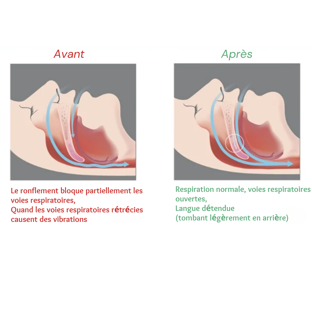 "Orthèse Anti-Ronflement : Gouttière ergonomique en silicone souple, améliore le sommeil et réduit le ronflement."