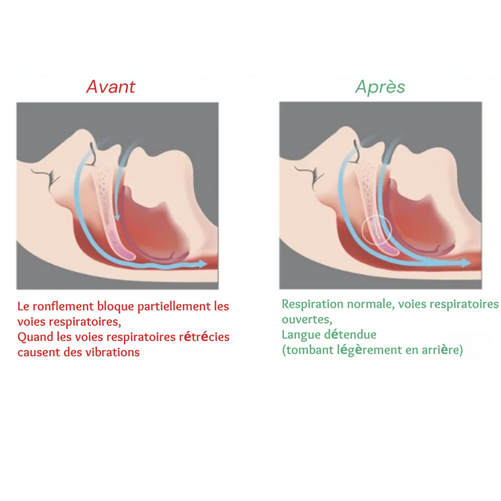 "Orthèse Anti-Ronflement : Gouttière ergonomique en silicone souple, améliore le sommeil et réduit le ronflement."