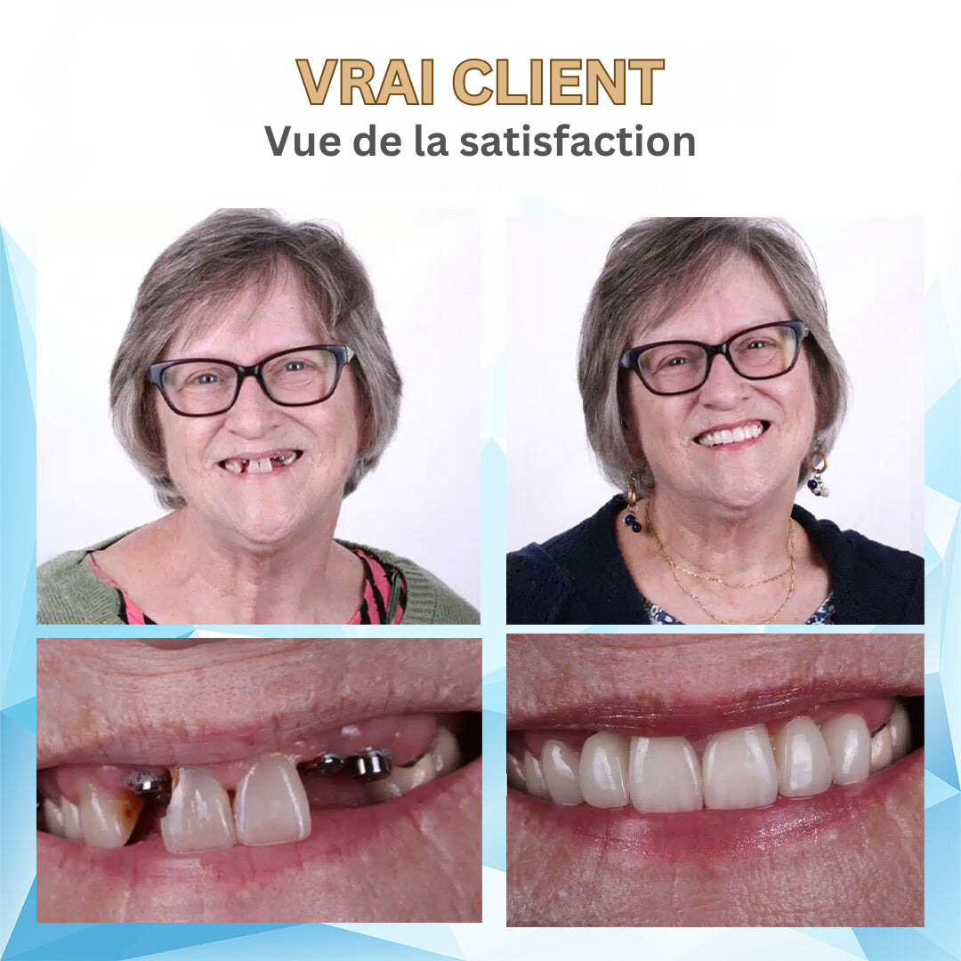 Prothèse dentaire amovible ergonomique, offrant un soutien optimal et un sourire naturel.