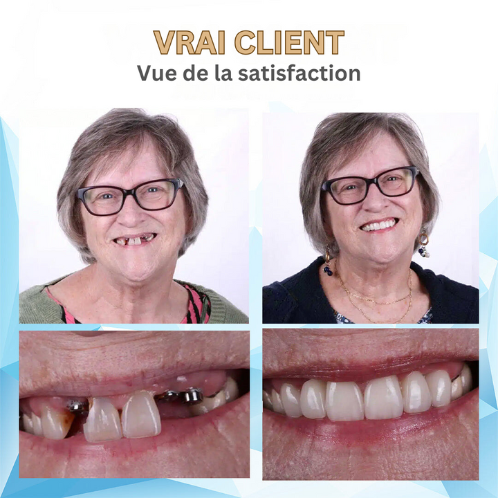 Prothèse dentaire amovible ergonomique, offrant un soutien optimal et un sourire naturel.
