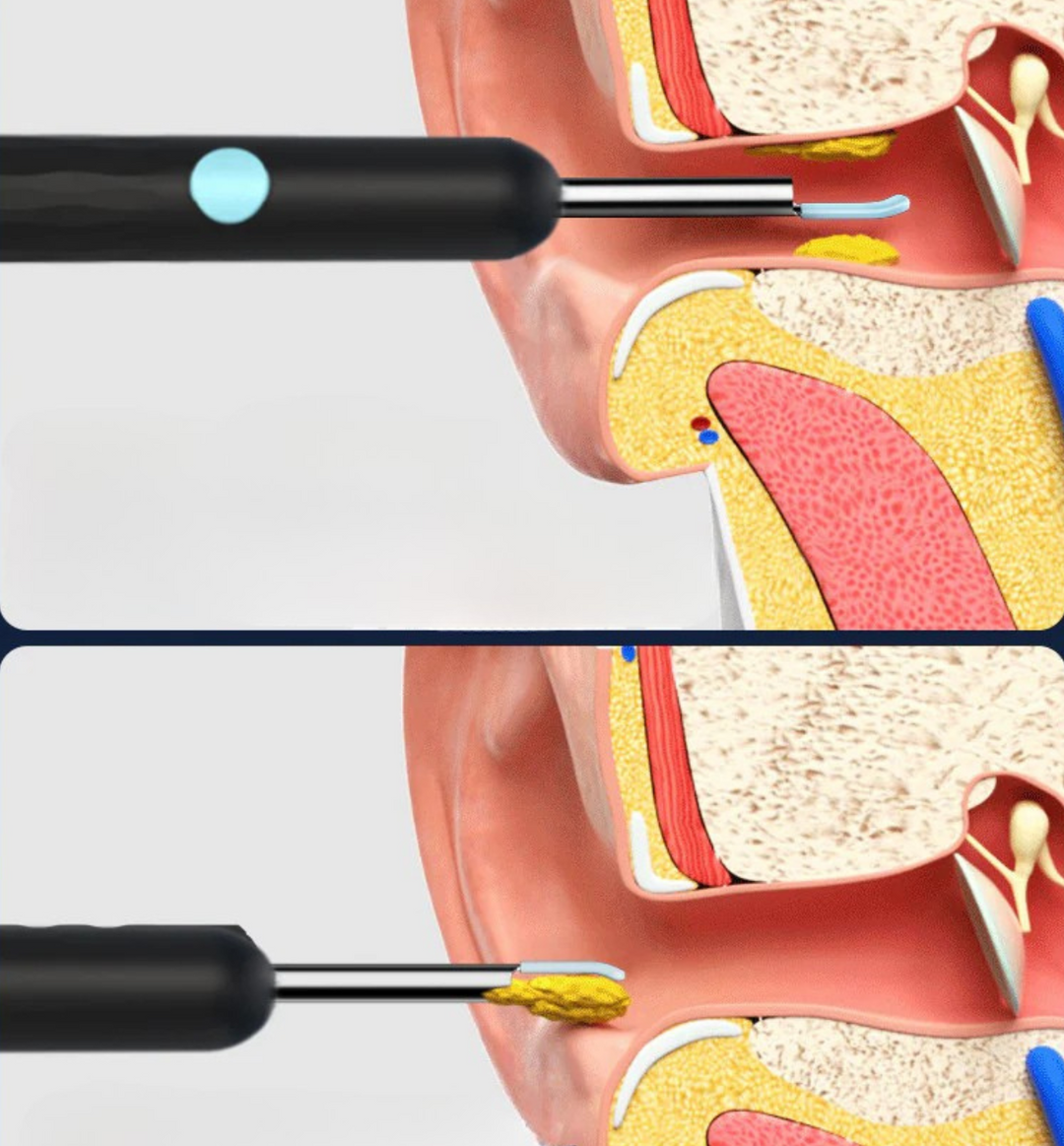 Caméra auriculaire LED HD. Nettoyage oreilles facile et sûr.  Visibilité optimale grâce à 6 LED.
