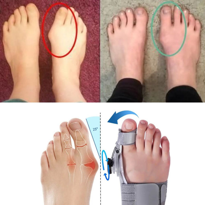 Correcteur discret hallux valgus, soulagement douleur, design confortable, adapté chaussures, utilisation quotidienne.