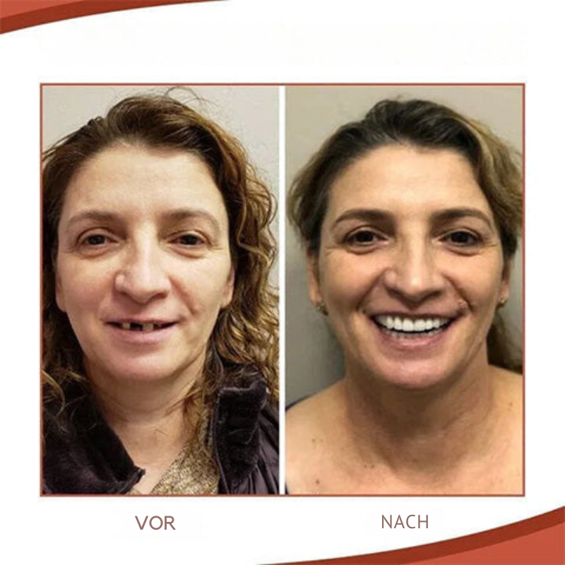 Prothèse dentaire supérieure et inférieure en silicone pour adultes, procurant un ajustement sûr et durable.