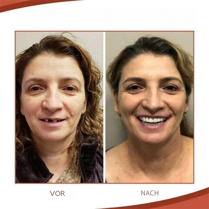 Prothèse dentaire supérieure et inférieure en silicone pour adultes, procurant un ajustement sûr et durable.
