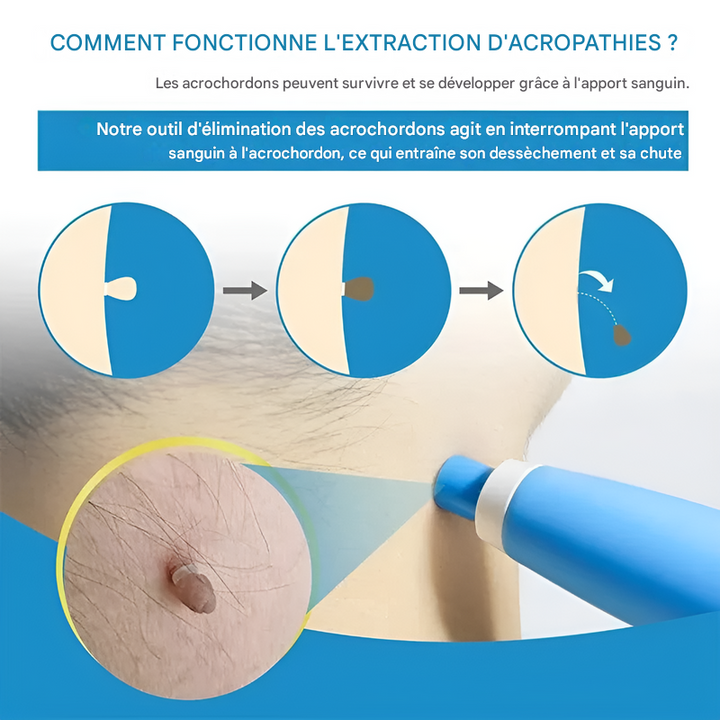 "Kit cryothérapie pour acrochordons, contient 2 appareils, compact et facile à utiliser, pour élimination rapide à domicile."