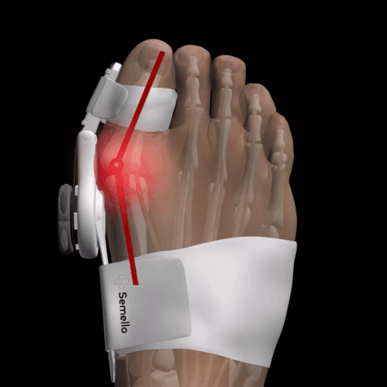 "Orthèse correctrice hallux valgus beige, ajustable, soulagement douleur et confort optimal pour gros orteil."